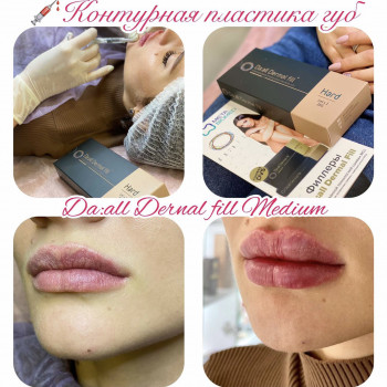 Контурна пластика губ