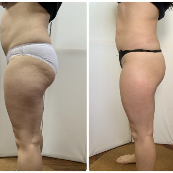 Корекции фігури