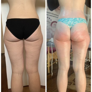 Корекции фігури