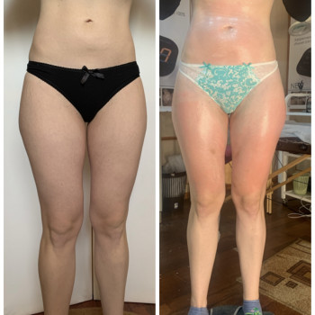 Корекции фігури