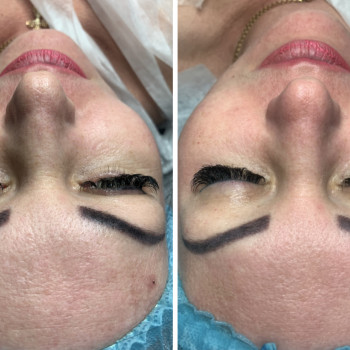 Чистка обличчя