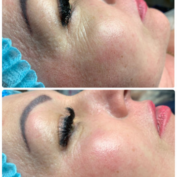 Карбоксітерапія