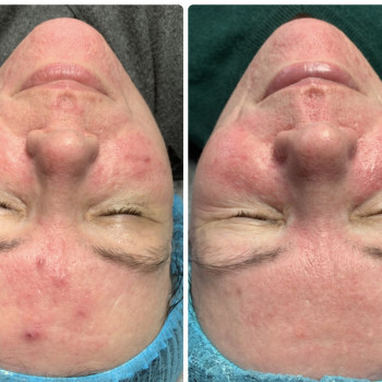 Лікування пкне