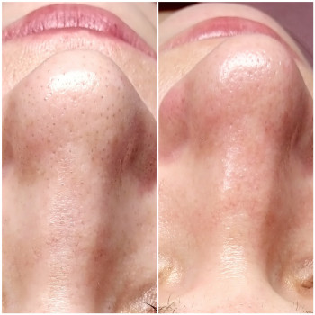 Чистка лица