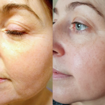 Результат антиэйдж массажа