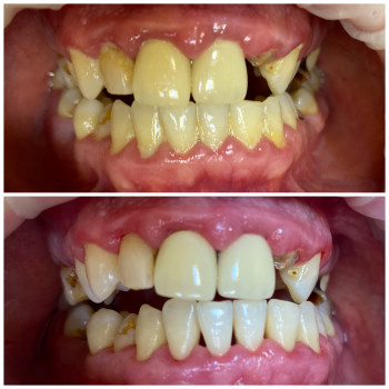 Професійна гігієна ротової порожнини