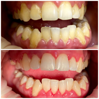 Професійна гігієна ротової порожнини Хмельницький