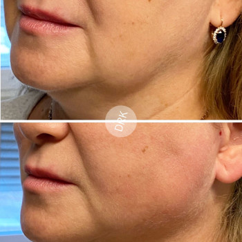 Корекція овала нитками