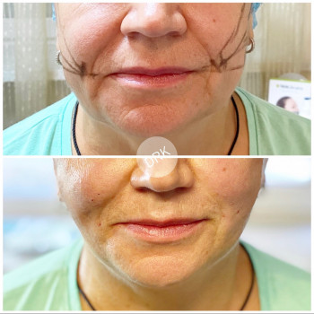 Корекція овала нитками