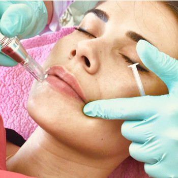 Без ін’єкційна корекція губ