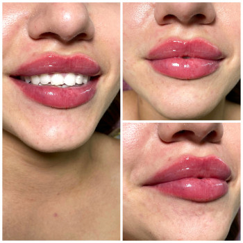 Добавили еще 1 мл препарата Neuramis deep. Сумарно в губах 2