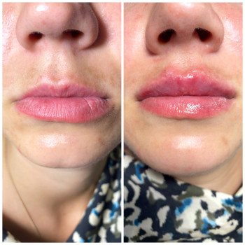 Задача была немного добавить обьём в верхнюю губу. Ушло 0,5 