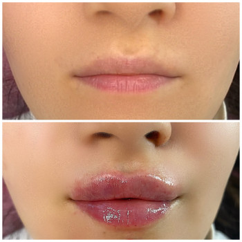 Первичные губки 1 мл Neuramis deep