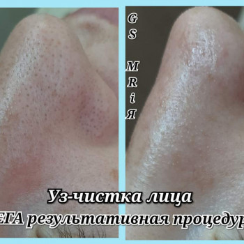 Ультразвуковая чистка лица
                    Салон красоты Мрія Житомир