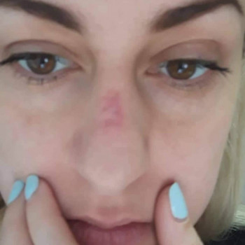 лікування шрамів на обличчі