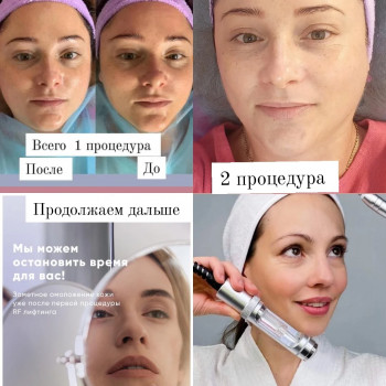 RF ліфтинг на апараті Zemits
                    Косметолог Лілія Винница