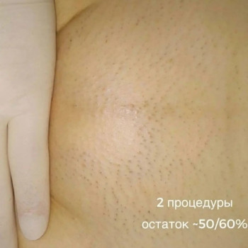 Лазерна епіляція (діодний лазер)
                    Салон красоты Beauty Line Запорожье