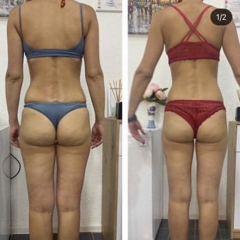 Вакуумный массаж
                    Косметолог Дарья Мариуполь