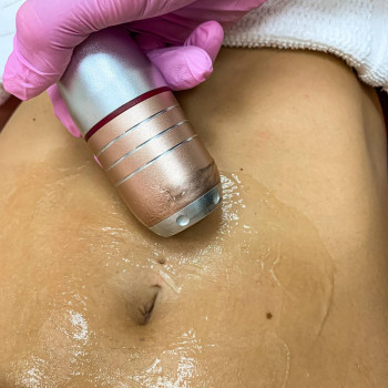 СМАС подтяжка живота