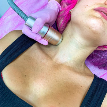 СМАС подтяжка шеи и подбородка