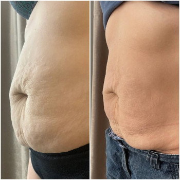 Гипсование живота
                    Косметологический центр Lazer Love Харьков