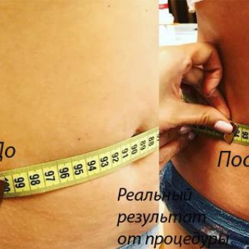 Гипсование живота
                    Косметологический центр Lazer Love Харьков