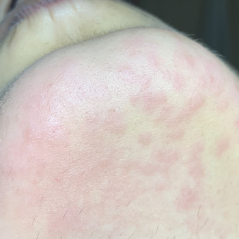 Зона подбородок
Реакция кожи сразу после процедуры. Из-за н