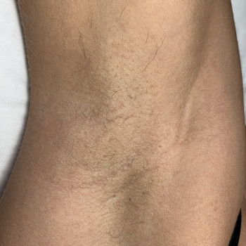 Зона подмышечных впадин 
Сделано 7 процедур. Осталось подоб