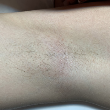 Зона подмышечных впадин 
Сделано 8 процедур 
Подбираем ост