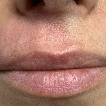 Зона усики
Реакция кожи сразу после процедуры