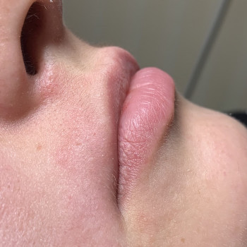 Зона усики 
Реакция кожи сразу после процедуры