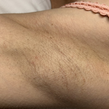 Зона подмышечных впадин 
Сделано 7 процедур 
Осталось подо