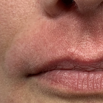 Зона усики 
Реакция кожи сразу после процедуры