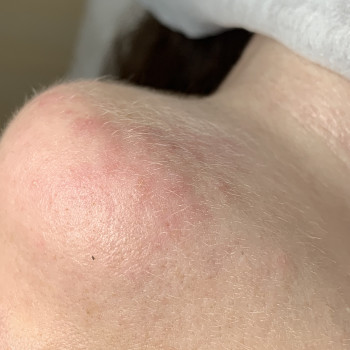 Зона подбородок 
Реакция кожи сразу после процедуры