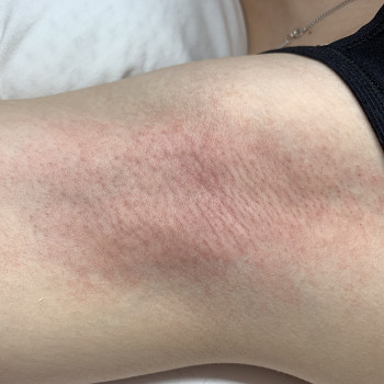 Зона подмышечных впадин 
Реакция кожи сразу после процедуры