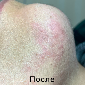 Зона подбородок 
Реакция кожи сразу после процедуры