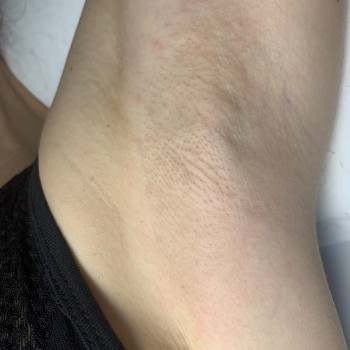 Зона подмышечных впадин 
Реакция кожи сразу после процедуры