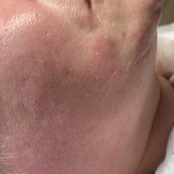 Зона щека
Реакция кожи сразу после процедуры 
Отёчность и 