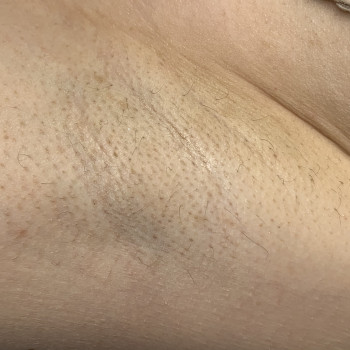 Зона подмышечных впадин 
Сделано 5 процедур