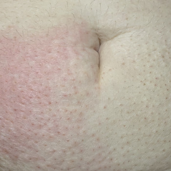 Зона живот
Слева реакция кожи сразу после процедуры, справа