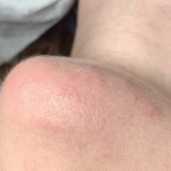 Зона подбородок 
Реакция кожи сразу после процедуры