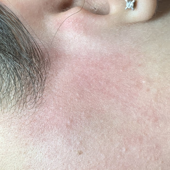 Зона бакенбарды 
Реакция кожи сразу после процедуры