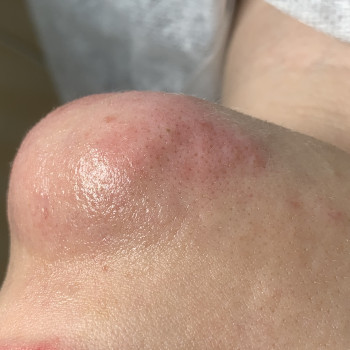 Зона подбородок 
Реакция кожи сразу после процедуры