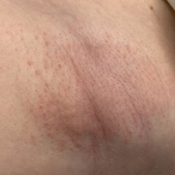 Зона подмышечных впадин 
Реакция кожи сразу после процедуры