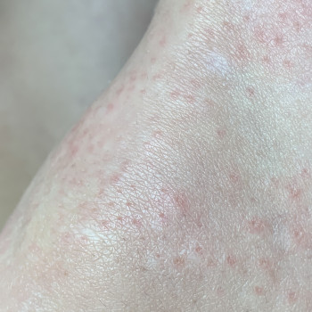 Зона коленки
Реакция кожи сразу после процедуры