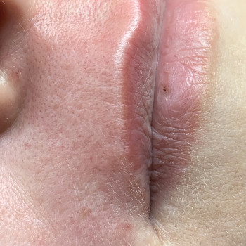 Зона усики 
Реакция кожи сразу после процедуры. Краснота и 