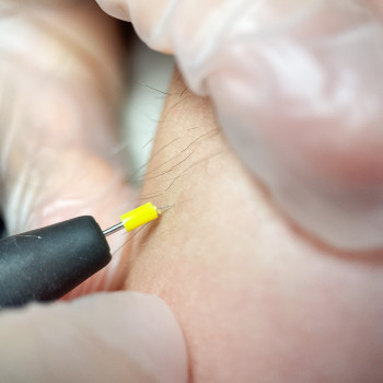 Электроэпиляция
                    Мастер депиляции Татьяна Мариуполь