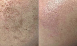Лікування пігментації IPL Косметологический центр O.L.Beauty Киев