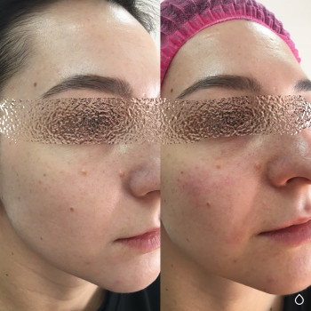 Щечки-яблочки
Контурная пластика скул