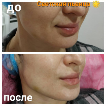 увеличение губ, уколы ботокса для лица, коррекция морщин